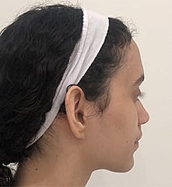 Otoplasty Before & After