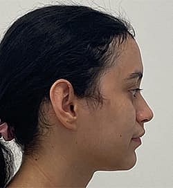 Otoplasty Before & After