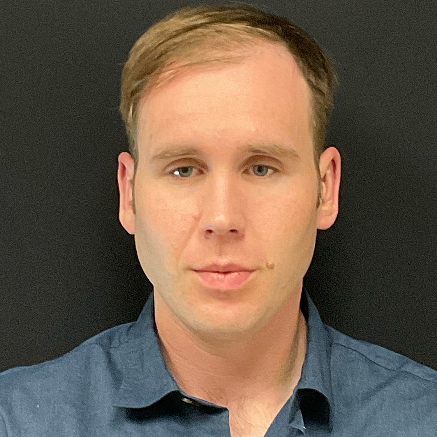 Otoplasty Before & After