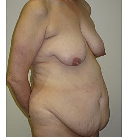 Mommy Makeover Before & After