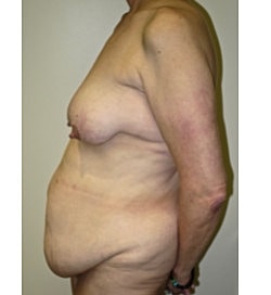 Mommy Makeover Before & After