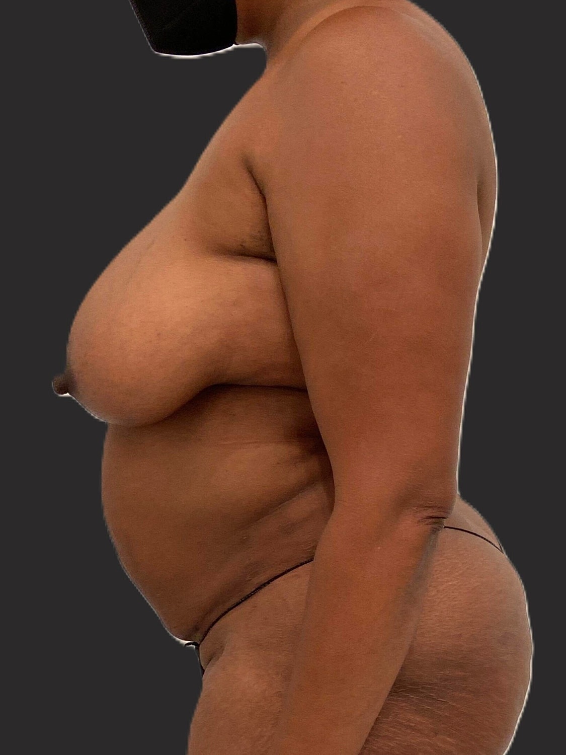 Mommy Makeover Before & After