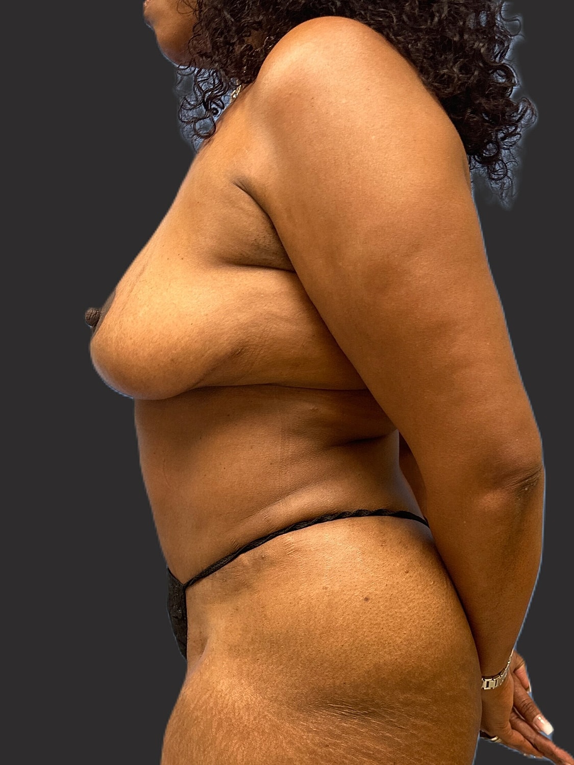 Mommy Makeover Before & After