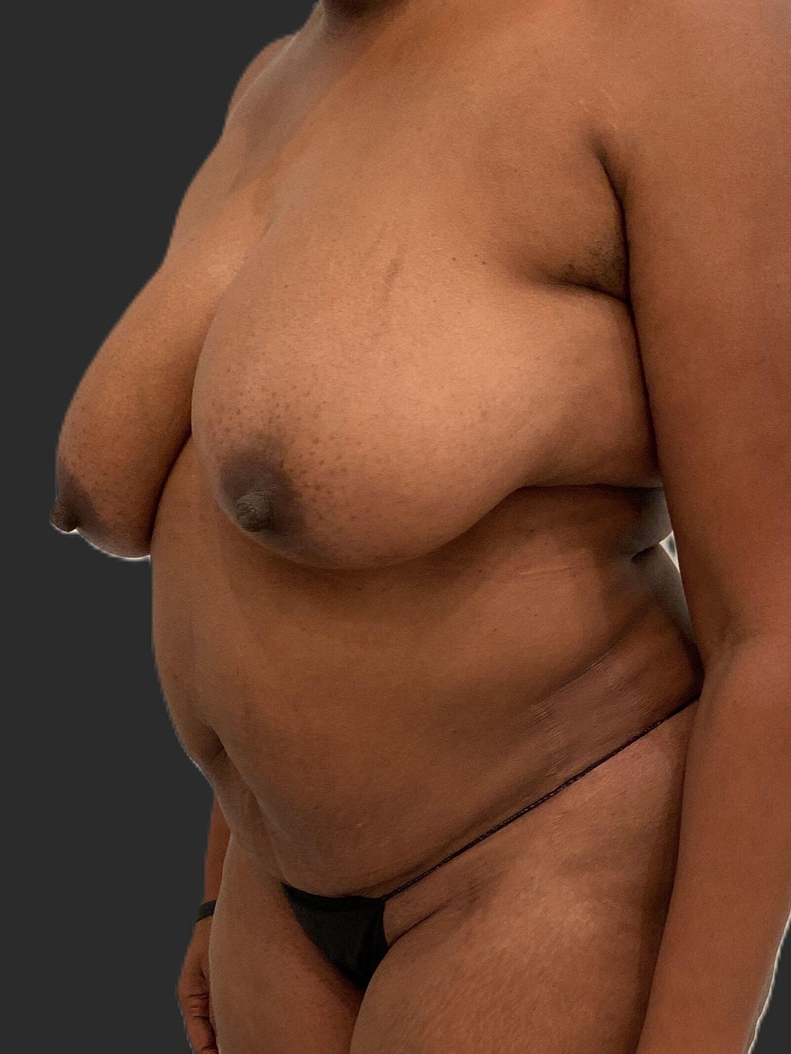 Mommy Makeover Before & After