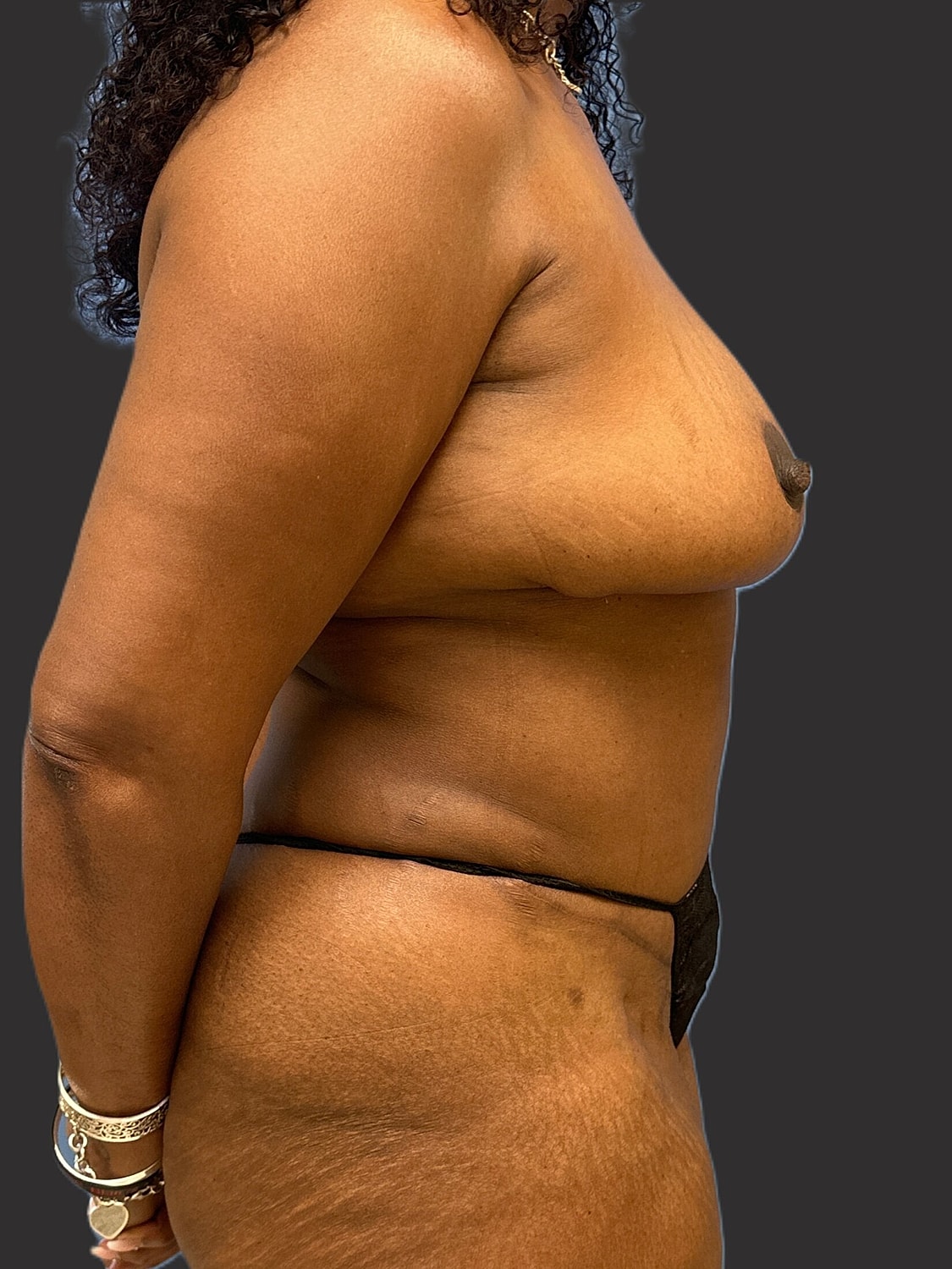 Mommy Makeover Before & After