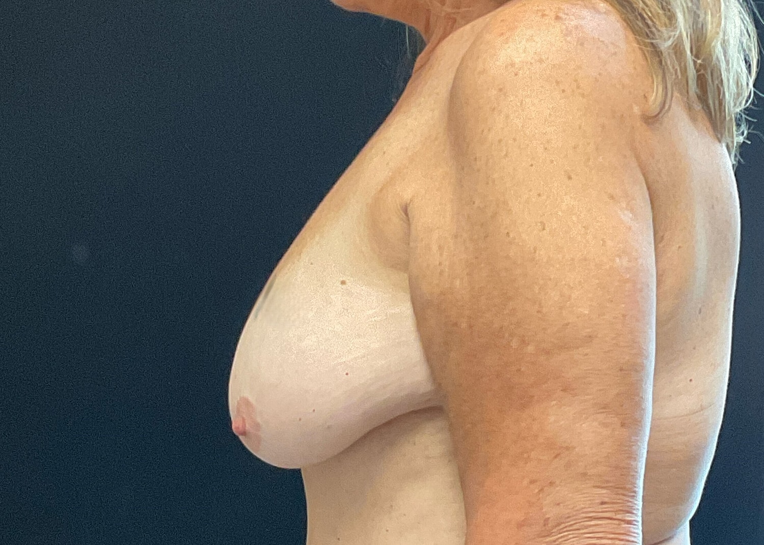 Breast Lift With Implant Before & After