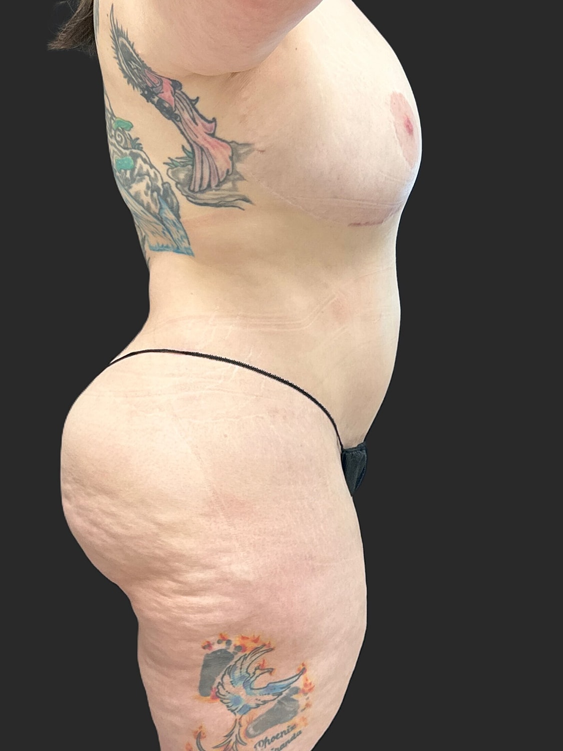 Brazilian Butt Lift Revision Before & After