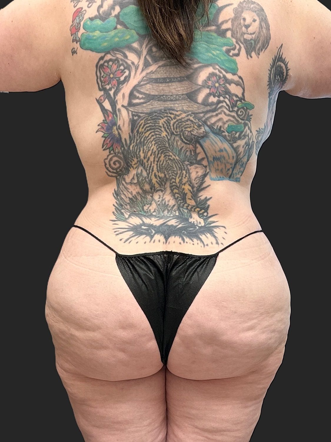 Brazilian Butt Lift Revision Before & After