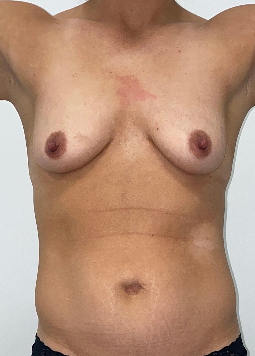 Breast Augmentation Fat Transfer Before & After