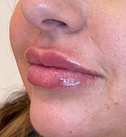 Lip Filler Before & After