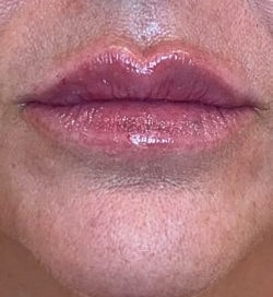 Lip Filler Before & After