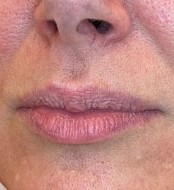 Lip Filler Before & After