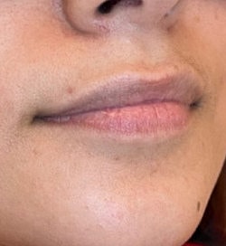 Lip Filler Before & After