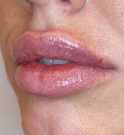 Lip Filler Before & After