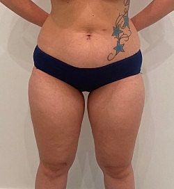 Liposuction Before & After