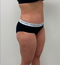 Liposuction Before & After