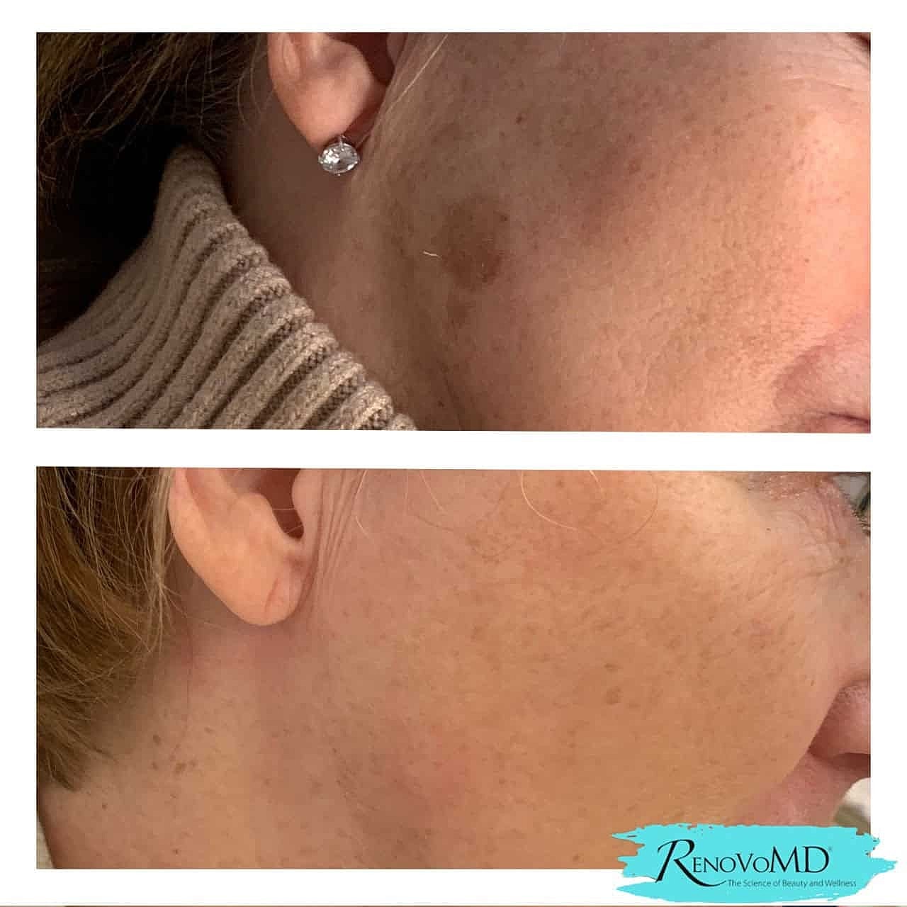 How to Achieve a Radiant Complexion with Laser Skin Resurfacing