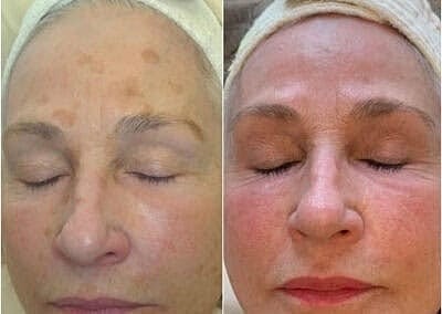 How to Achieve a Radiant Complexion with Laser Skin Resurfacing - Image 2