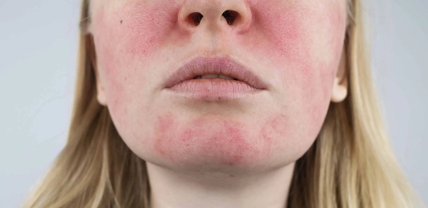 Rosacea Symptoms & Treatment