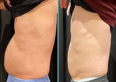 truSculpt vs. CoolSculpting: Is It Better to Freeze or Melt Fat? - Image 3
