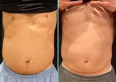 truSculpt vs. CoolSculpting: Is It Better to Freeze or Melt Fat?