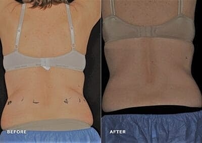 truSculpt vs. CoolSculpting: Is It Better to Freeze or Melt Fat? - Image 6