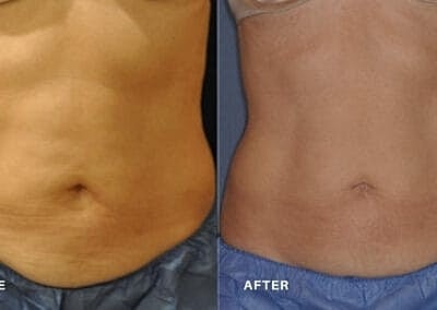 truSculpt vs. CoolSculpting: Is It Better to Freeze or Melt Fat? - Image 2