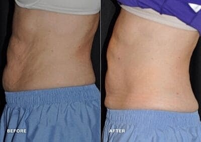 truSculpt vs. CoolSculpting: Is It Better to Freeze or Melt Fat? - Image 4