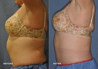 truSculpt vs. CoolSculpting: Is It Better to Freeze or Melt Fat? - Image 5