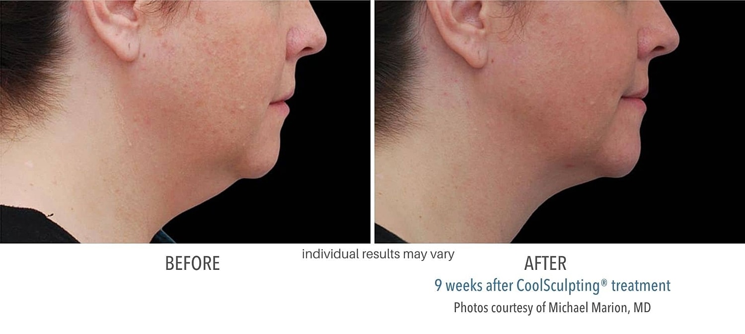 Is New Always Better? Why You Should Stick to Original CoolSculpting - Image 4