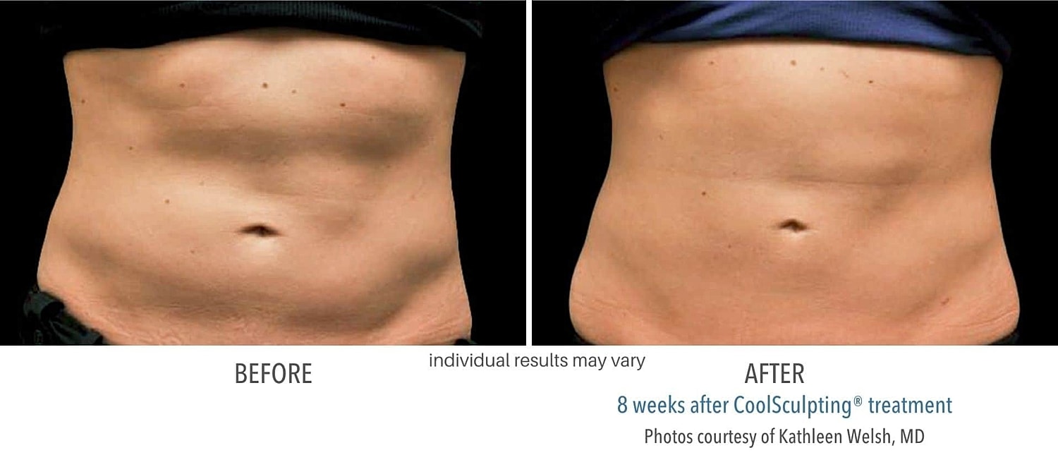 Is New Always Better? Why You Should Stick to Original CoolSculpting - Image 5