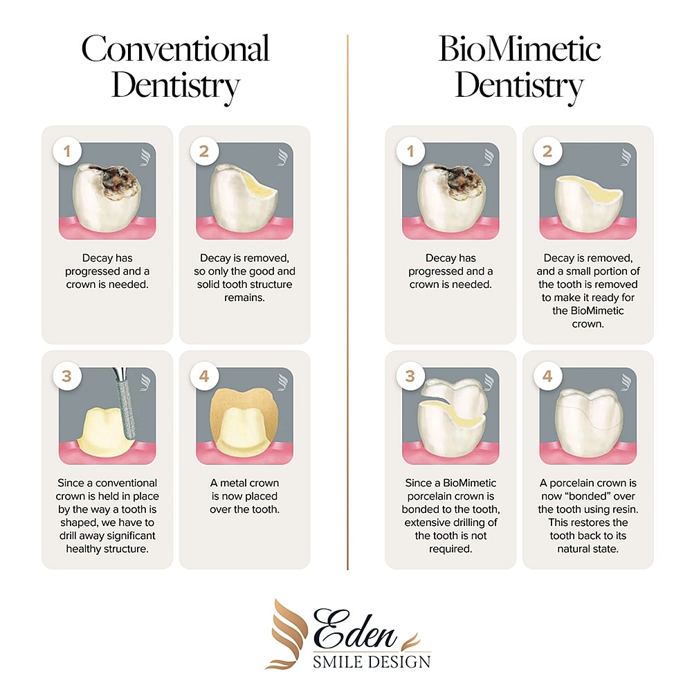 Biomimetic Dentistry vs. Traditional Crowns
