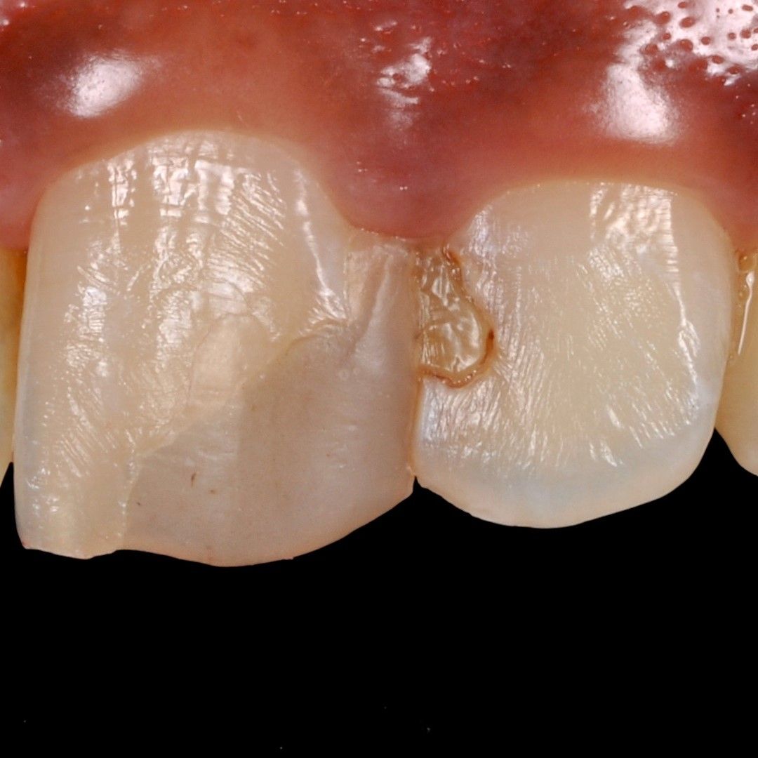 Front Tooth Filling Restoration before