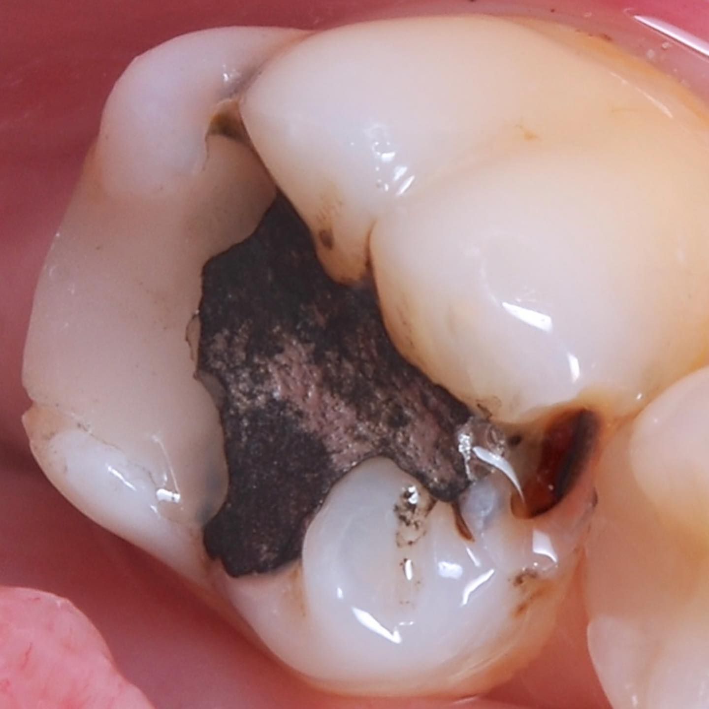 Back Tooth Filling Restoration before