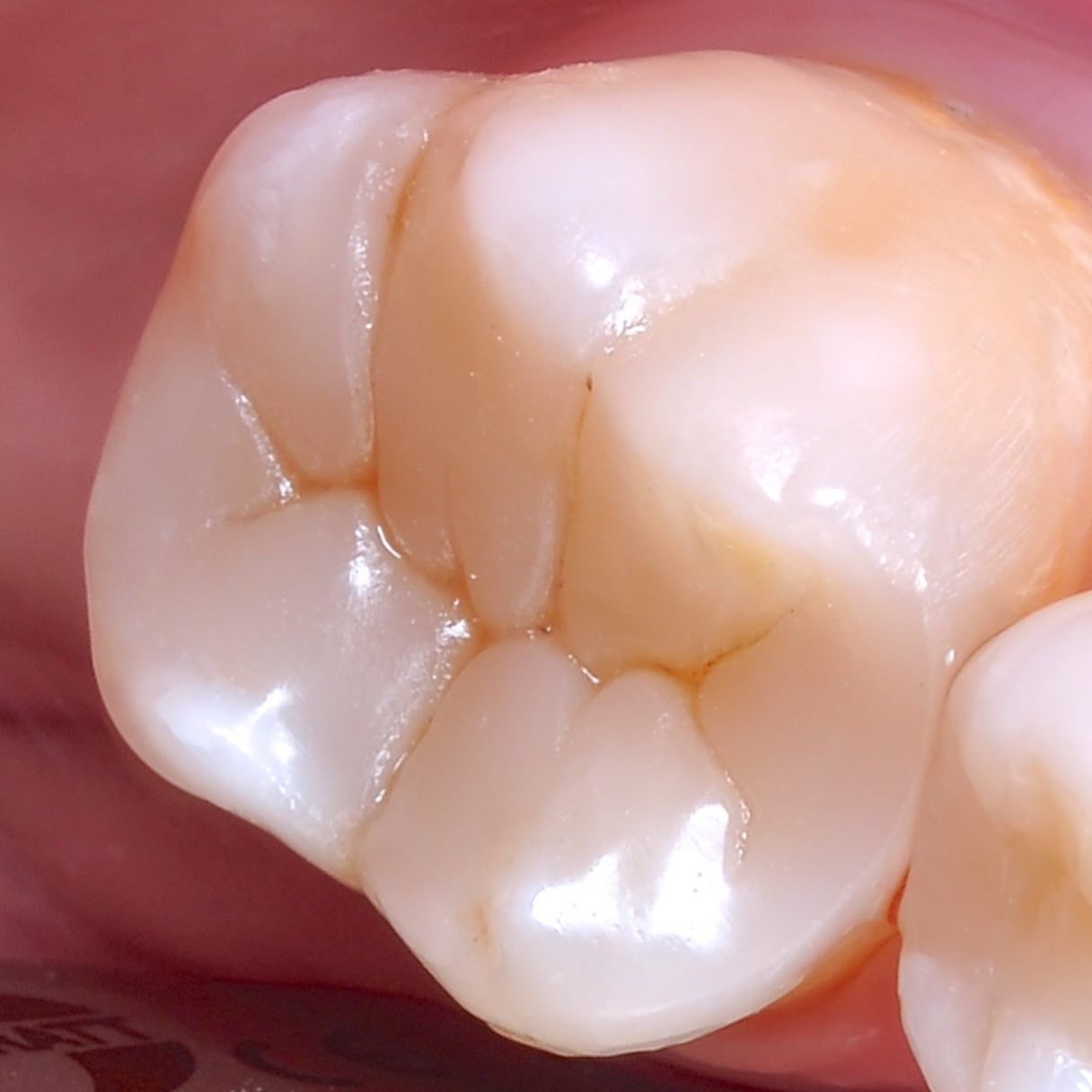 Back Tooth Filling Restoration after