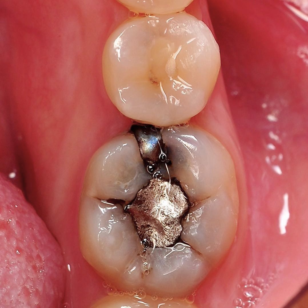 Back Tooth Filling Restoration before