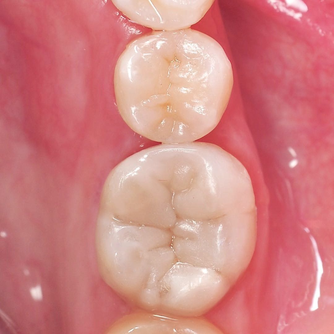 Back Tooth Filling Restoration after