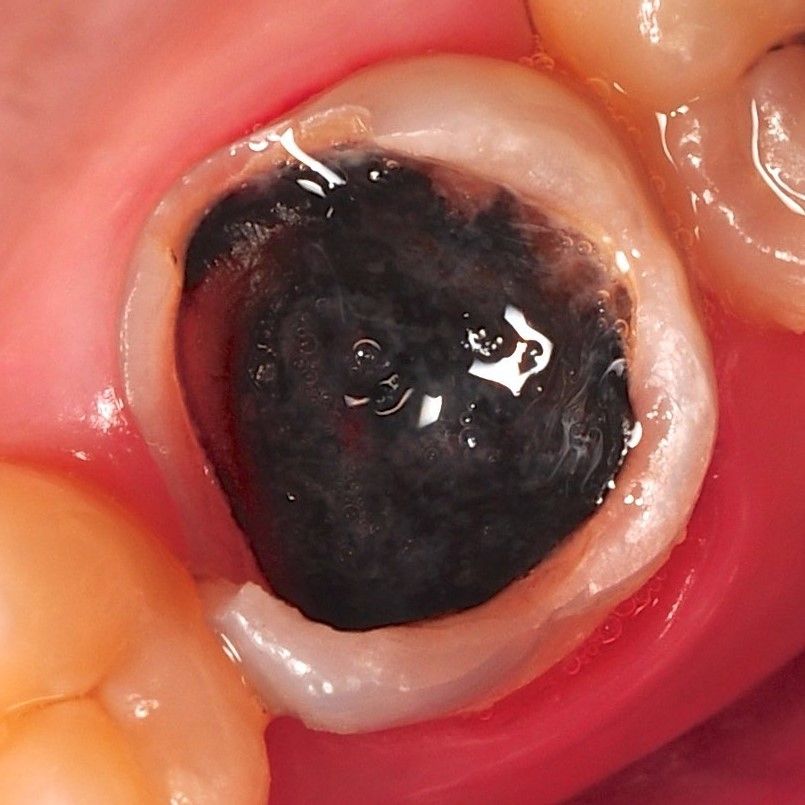 Back Tooth Filling Restoration before