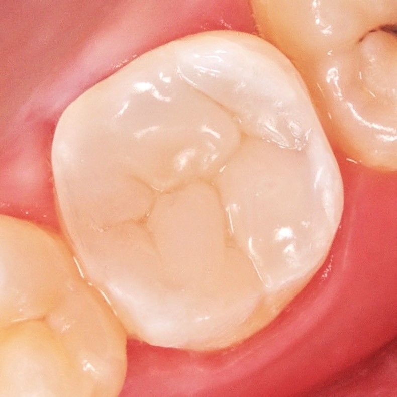 Back Tooth Filling Restoration after