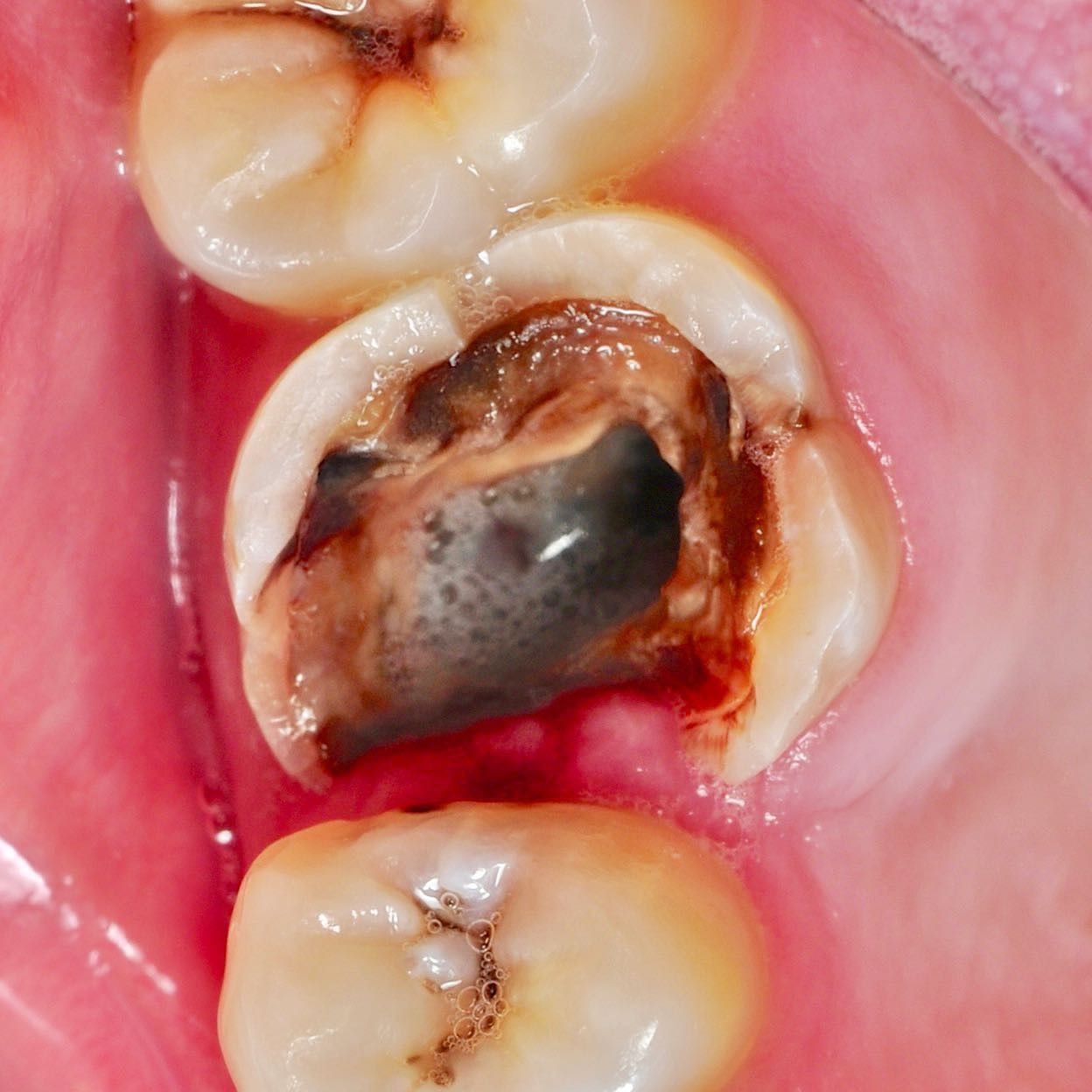 Back Tooth Filling Restoration before