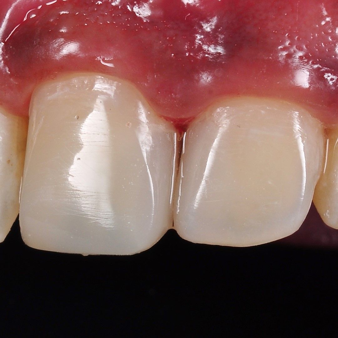 Front Tooth Filling Restoration after