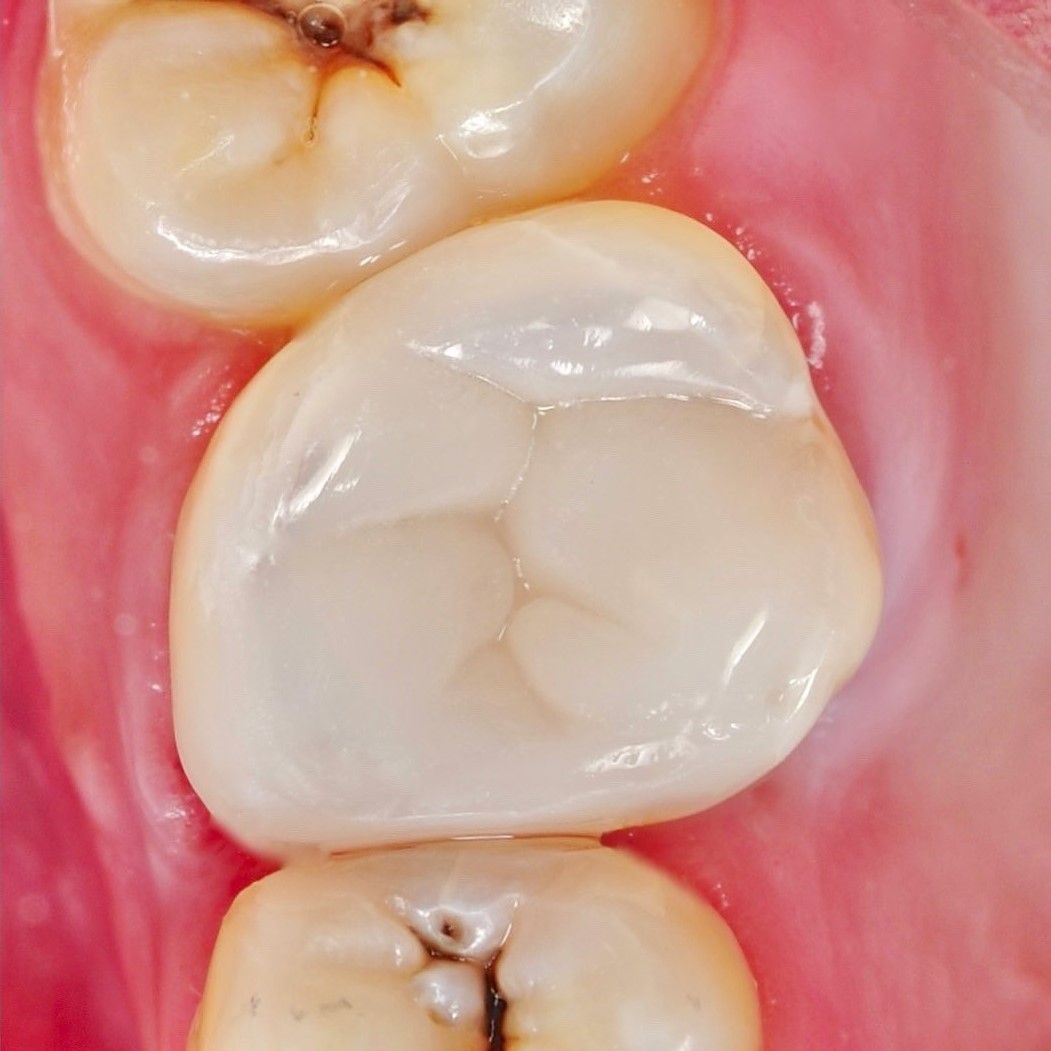 Back Tooth Filling Restoration after