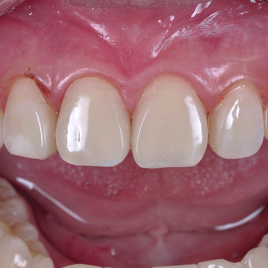 Front Tooth Filling Restoration after