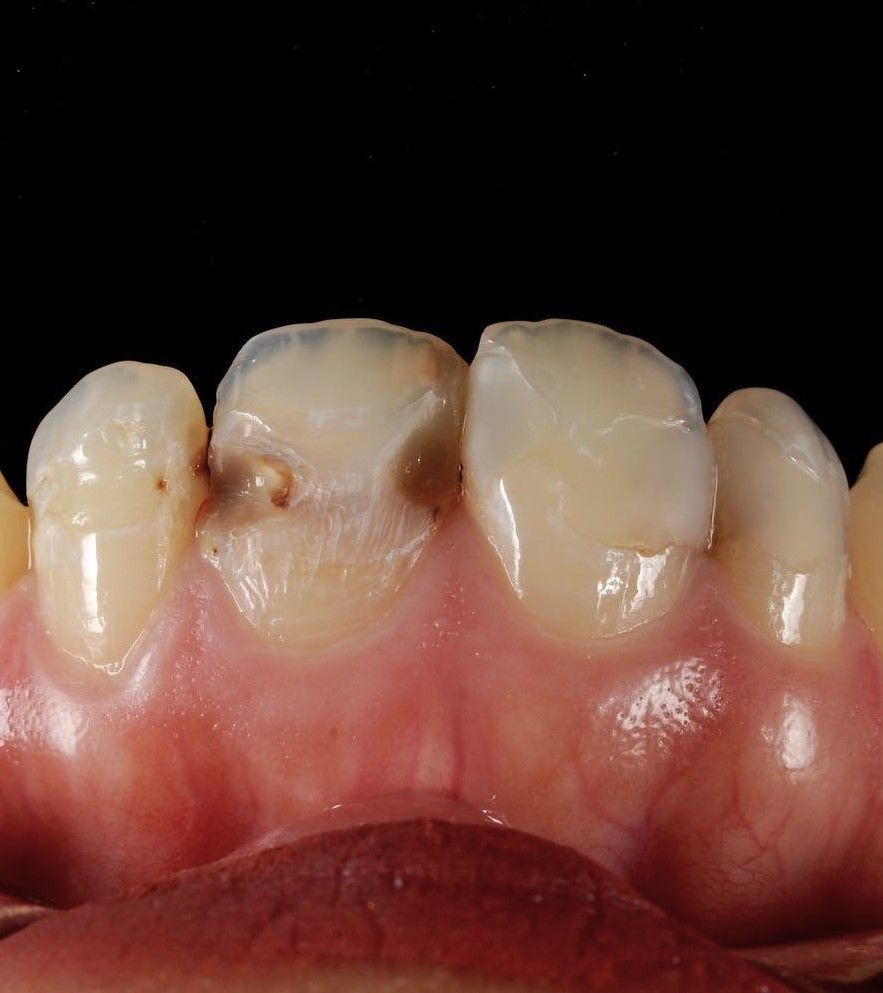 Front Tooth Filling Restoration before