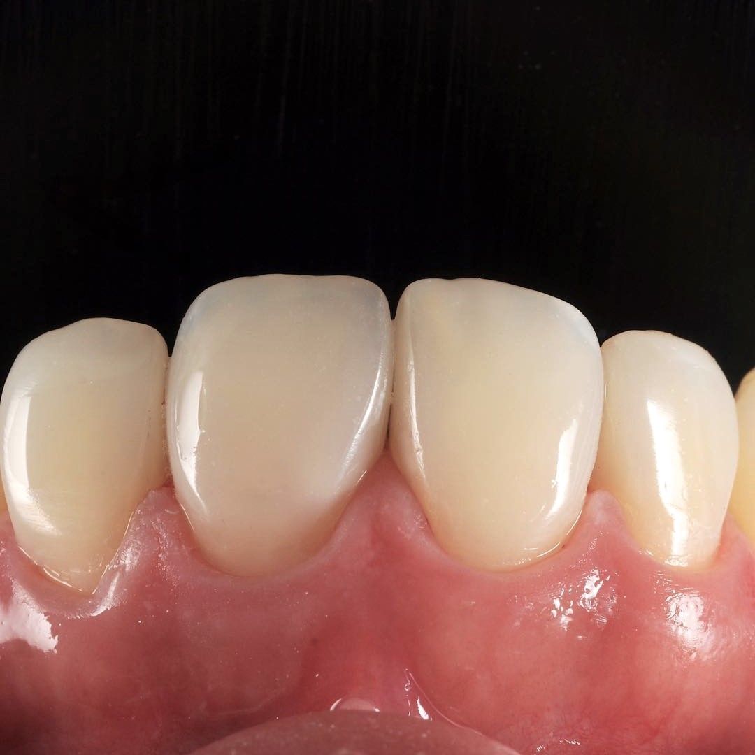 Front Tooth Filling Restoration after