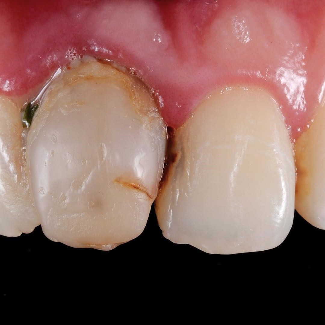 Front Tooth Filling Restoration before