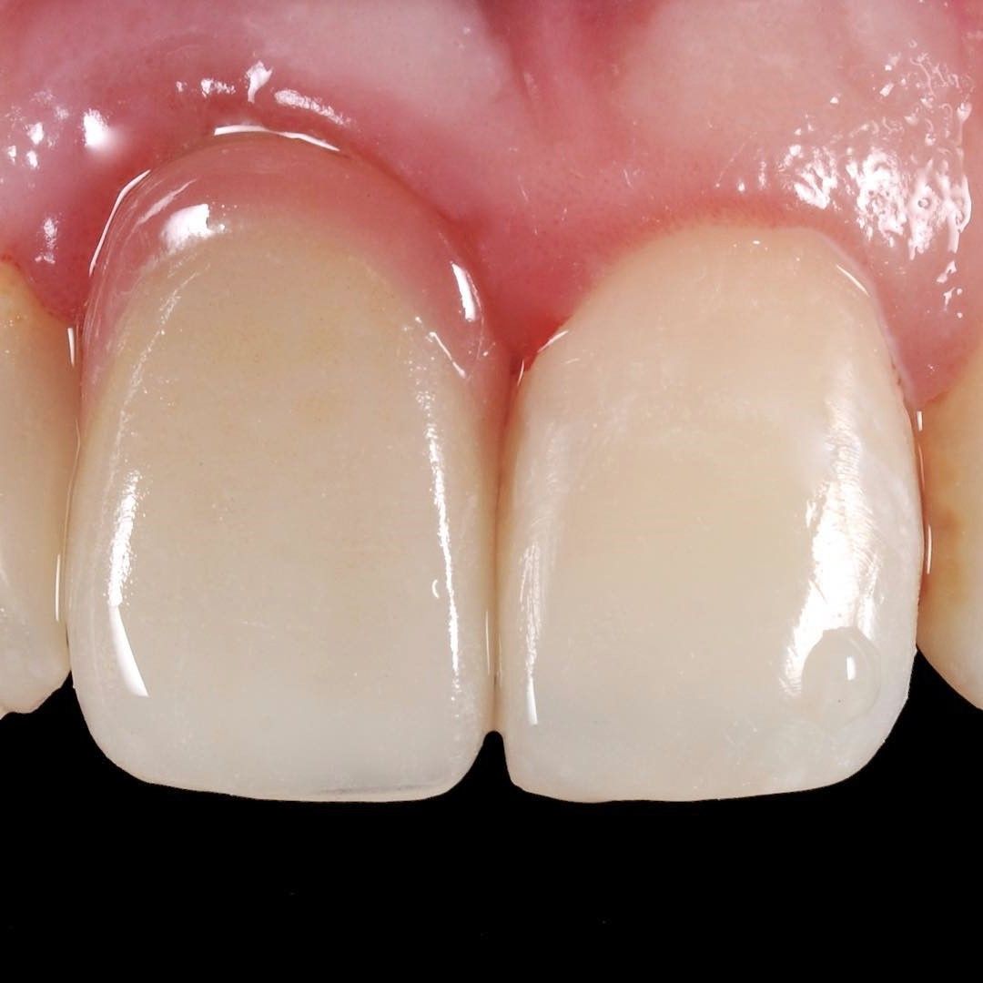 Front Tooth Filling Restoration after
