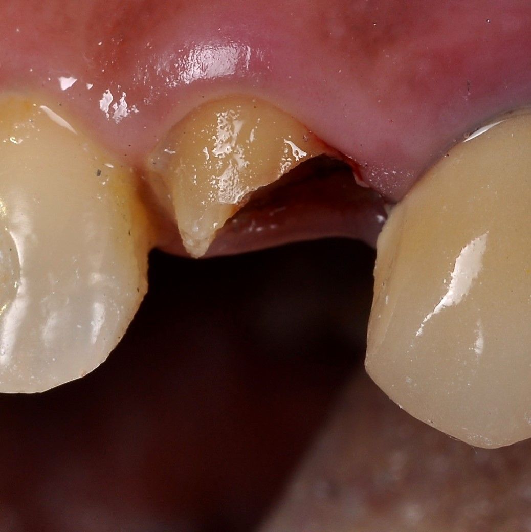 Front Teeth Repair of Grinding Fractures before