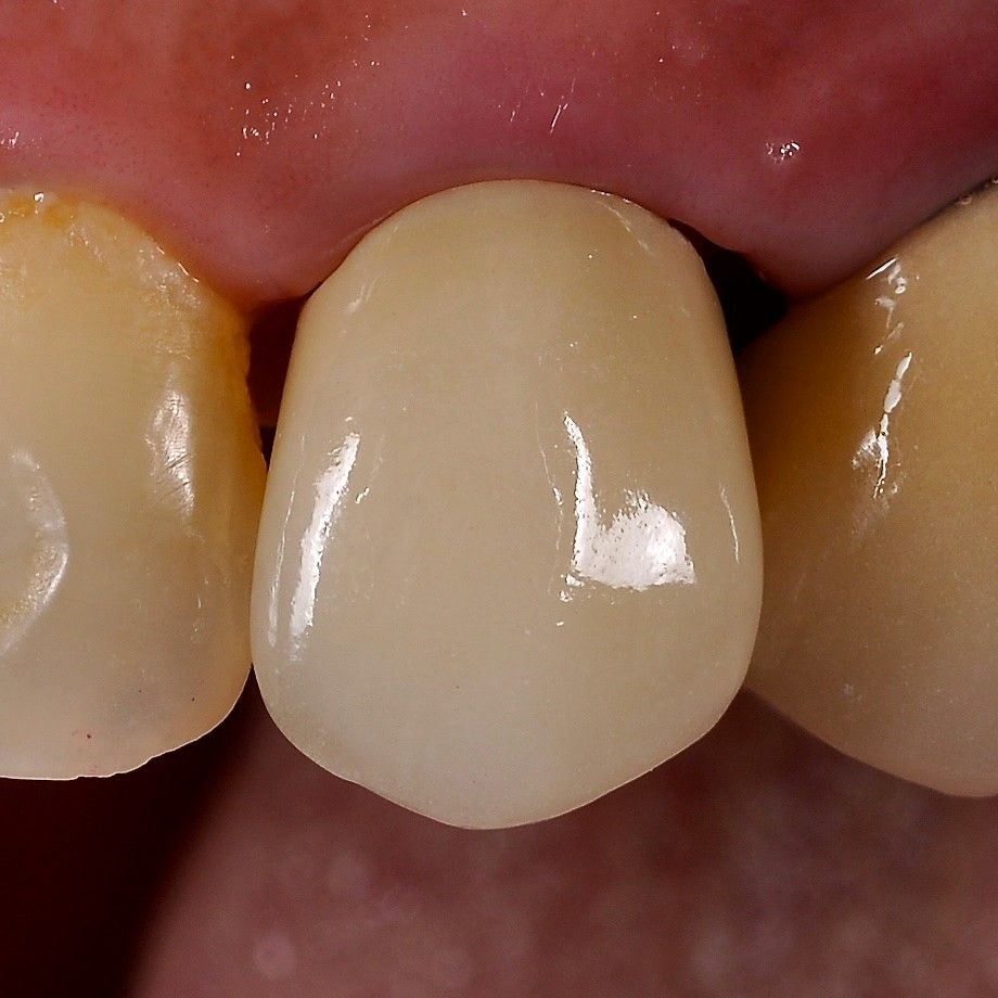 Front Teeth Repair of Grinding Fractures after