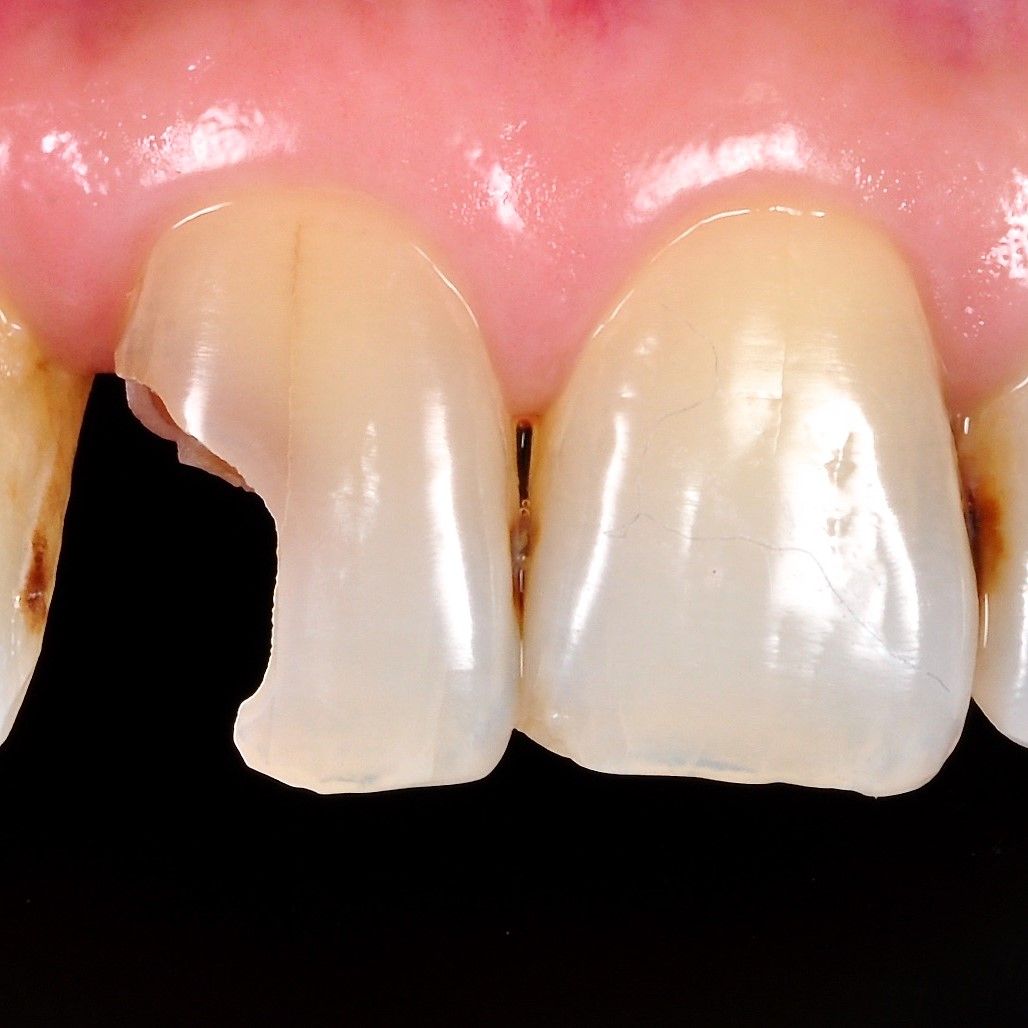 Front Teeth Repair of Grinding Fractures before